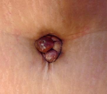 Klinische Bilder von umbilikaler Endometriose (Quelle: Chakraborty, Slide Share)