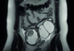 Krebs und Kinderwunsch I – Eine Übersicht zum Thema ­Onkofertilität in der gynäkologischen On-kologie