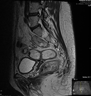 Abb. 1. Raumforderung zu den Nervenwurzeln L5 rechts und S1 rechts (rote Pfeile).