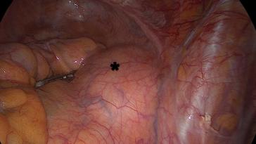 Abb. 2. Retroperitoneal im kleinen Becken gelegener Tumor (*)