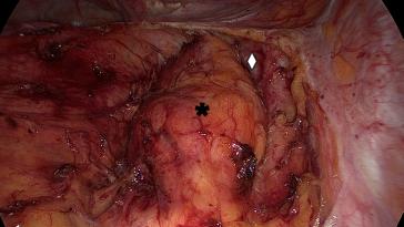 Abb. 3. Schrittweise Freipräparation des Tumors (*), angrenzend zur Arteria iliaca interna (◊)
