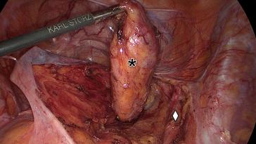 Abb. 4. Exzision des Tumors in toto (*), Arteria iliaca interna (◊)