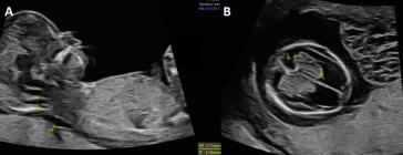 Bild 1: Panel A: Seitenansicht des Feten mit Hypognathie und einer NT >99. Perzentile. Panel B: Disproportion zwischen Hirnseitenventrikel und den ipsilateralen Plexii choriodei.