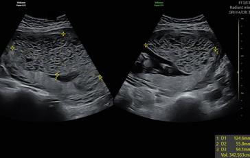 Bild 2: Grossvolumiger, mit kleinen Zysten durchsetzter Tumor an der Vorderwand. An der Hinterwand normal imponierende Plazenta.