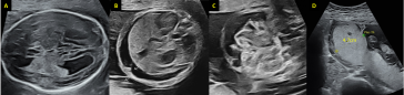 Abb. 1. (A) BIP-Ebene mit angedeutet erweiterten Hirnseitenventrikel; (B) Aszites; (C) echogener Darm;  (D) verdickte Plazenta