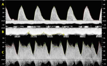 Abb. 2. (A) AEDF in der Nabelschnurarterie; (B) biphasische Pulsationen in der NS-Vene; (C) Ductus venosus mit diesem typischen zweigipfligen Flussmuster
