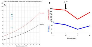 Grafik 2. (A) Alle gemessenen ACM Geschwindigkeiten lagen deutlich >1.5 MoM; (B) nach IUT ist die PSV kurzfristig abgefallen um dann am folgenden Tag wieder anzusteigen