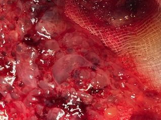 Abb. 1. Choriales Material nach Saug curettage. Man sieht Gewebe welches diffus mit kleinen Zysten durchsetzt ist. Dieses Gewebe entspricht der moligen Plazenta