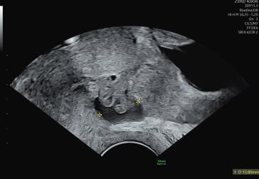 Abbildung 1: Befund bei Erstvorstellung in der 13. Schwangerschaftswoche