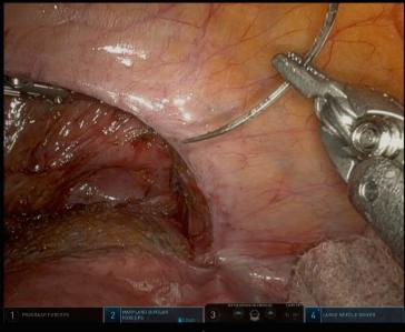 Abbildung 2A: Nach Präparation des Defekts