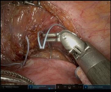 Abbildung 2B: Platzierung der Nähte