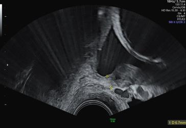 Abbildung 3: Unteres Uterinsegment bei Gestationsalter 23+5