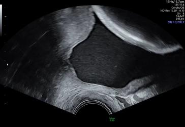 Abbildung 3: Unteres Uterinsegment bei Gestationsalter 27+5