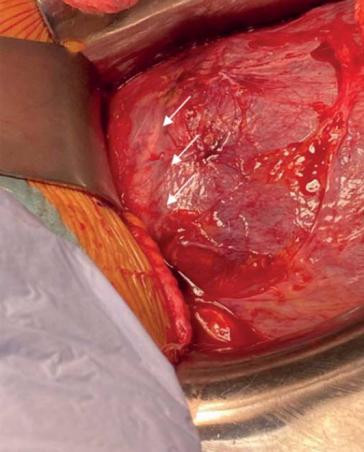 Abbildung 4: Intraoperatives Bild während der Sectio caesarea, das Myometrium ist nach wie vor über dem Defekt (Pfeile) adaptiert 