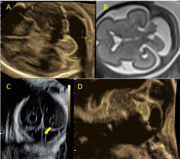 Abbildung 1. A) transzerebellare Ebene mit Darstellung der hinteren Schädelgrube. Deutlich unterschiedliche Kleinhirn­hemisphären mit ­weiter Cisterna magna; (B) fetales MRI bestätigt die sonographischen Befunde; (C) okzipitale Frontal­ansicht mit nach links von der ­Medianen liegenden Falx (gelber Pfeil); (D) Vermisbiometrie in ­Saggitalansicht