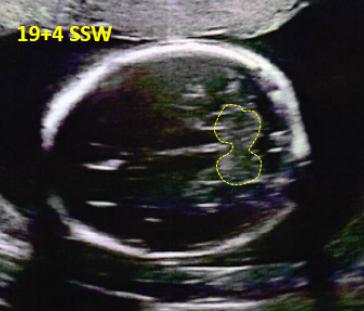 Abbildung 2. Transzerebellare Ebene in der 20. Woche. ­Kleinhirnhemisphären zu diesem Zeitpunkt gut darstellbar.