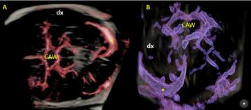 Abbildung 3. A) Circulus arteriosus Willisii (CAW) symmetrisch; (B) Okzipitale Ansicht mit unterschiedlicher Darstellung der Sinus transversii. Auf der „normalen“ Seite des Kleinhirns sieht man einen schönen Sinus transversus (in beiden Bilder mit „*“ markiert), während auf der Gegenseite dieser nicht darstellbar ist.