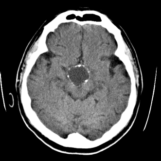 Abbildung 1. MRI-Bild Kraniopharyngeom (mit freundlicher Genehmigung von Prof. Dr. med F. J. Ahlhelm, Institut für Radiologie, Kantonsspital Baden)