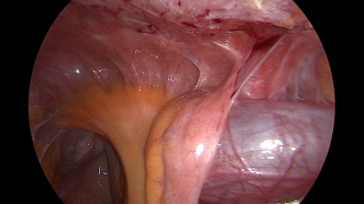 Abbildung 1. Dünndarmschlinge an den Bauchwand adhärent