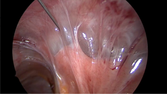 Abbildung 2. Sub- bzw. intraperitoneale Injektion von 1:100 verdünntem Empressin® zwischen Bauchwand und Dünndarmschlingen.