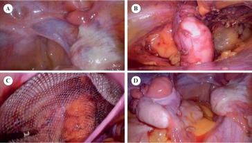 Abbildung 2. Intraoperativer Situs; A) zu Beginn; B) nach Lösen des Ovars aus dem Leistenkanal; C) Verschluss der Bruchpforte; D) Abschlussbild nach Pexierung des Ovars.
