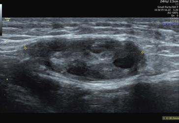 Abbildung 1. Sonographische Darstellung des Ovars mit ­Leistenkanal.