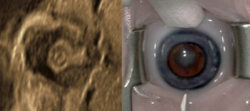 Abbildung 1. A Pränatales Bild der Linse mit diesem „double ring sign“; B präoperatives Bild