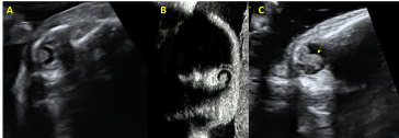 Abbildung 2. Andere Fälle mit Katarakten: A und B Katarakt bei Walker-Warburg-Syndrom; C thrombosierte Arteria hyaloidea (Pfeil) bei PHPV