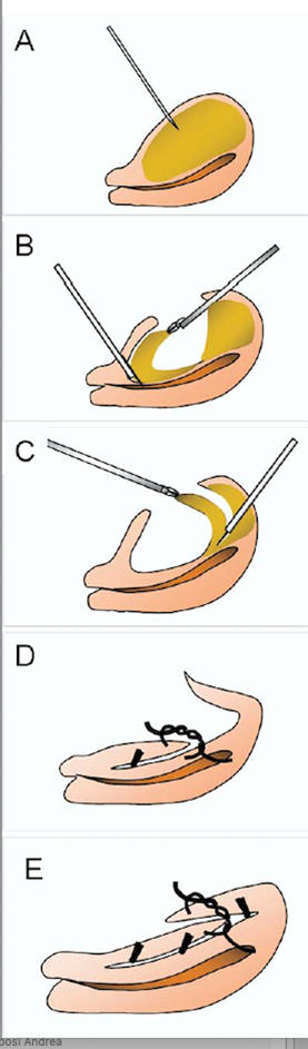 Abbildung 1: Operation nach Osada
