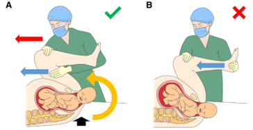 Abb. 2. McRoberts-Manöver. Durch die Extension und dann Hyperflexion durch Druck auf die Rückseite des Oberschenkels (blauer Pfeil) erreicht man, dass die Symphyse die Schulter frei gibt. Wird erreicht, indem man auf die Rückseite des Oberschenkels drückt (blauer Pfeil).