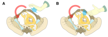 Abb. 3. Darstellung der zwei Rubin-Manöver. (A) Rubin I; (B) Rubin II