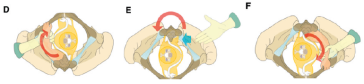 Abb. 5. Lösung des hinteren Armes. (D) Frau in Rückenlage; (E, F) Frau in Vierfüssler