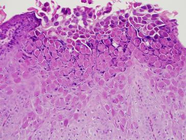 Abbildung 1. Becherförmige Läsion mit hyperplastischem Plattenepithel und grossen intrazellulären eosinophilen Einschlusskörperchen, den sog. Henderson-Paterson- oder Molluscum-Körperchen (HE-Färbung 200x; aus UAB virtual microscopy)