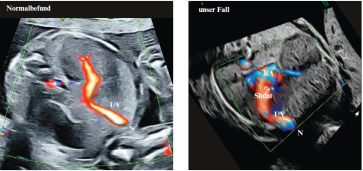 Abbildung 1. Gegenüberstellung von zwei Abdomenbilder mit Farbdoppler. In unserem Fall rechts verläuft die Umbilikalvene (UV) im Vergleich zum Normalbefund gebogen und links von der Medianen. Die UV mündet direkt in den rechten Vorhof (RA) ohne zwischengeschalteten DV und ohne mit den anderen venösen Systemen der Leber zu konfluieren. (N, Nabel)