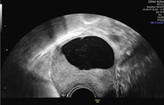 Abb. 1. Sonographische Darstellung des Befundes.