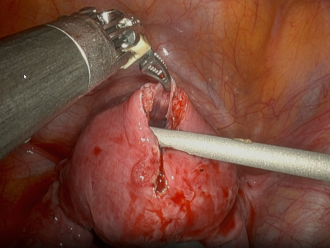 Abb. 3. Nach Eröffnung des Befundes.