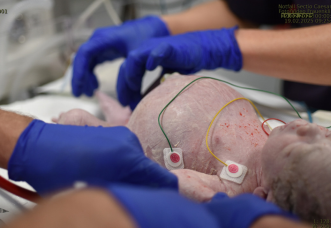 Abb. 1. Balloniertes Abdomen bei Aszites. Kind direkt nach der Entbindung.