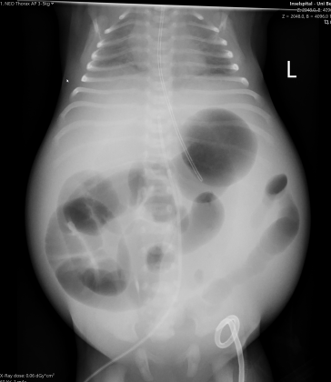 Abbildung 2. Rx Abdomen/Thorax: Lungenvolumen vermindert, Zwerchfellhochstand. Lungen bds. transparenzgemindert. Ausladendes Abdomen, Aszites, subkutanes Ödem, keine Verkalkungen.