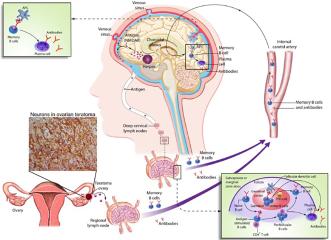 Abbildung 3. Auslöser der Anti-NMDA-Rezeptor-Enzephalitis und ein mögliches Modell der B-Zell-Aktivierung. Die Abbildung zeigt zwei identifizierte Auslöser der Erkrankung: einen Tumor (in der Regel ein Ovarialteratom) und, weitaus seltener, eine Herpes-simplex-Enzephalitis. Beim Ovarialteratom enthält das im Tumor vorhandene Nervengewebe Neuronen und NMDA-Rezeptoren, die wahrscheinlich durch tumorbedingte nekrotische Veränderungen freigesetzt werden und die lokalen, pelvin-abdominalen Lymphknoten erreichen. Bei Herpes-simplex-Enzephalitis können die ausgeprägt virusinduzierte Entzündung, Gewebenekrose und neuronale Degeneration das Antigen freisetzen, das zu den lokalen das Gehirn drainierenden tiefen zervikalen Lymphknoten transportiert wird (ein alternativer Weg führt über die Venensinus). In den Lymphknoten (pelvin-abdominal oder tief zervikal) wird das Antigen von antigen-präsentierenden Zellen in Zusammenarbeit mit CD4-positiven T-Zellen naiven B-Zellen präsentiert, was zur Bildung von Gedächtnis-B-Zellen und antikörperproduzierenden Plasmazellen führt. Aktivierte Gedächtnis-B-Zellen gelangen über den Blutkreislauf ins Gehirn, wobei sie den Plexus choroideus passieren; im Gehirn durchlaufen die aktivierten B-Zellen eine Restimulation, eine antigen-gesteuerte Affinitätsreifung und die Differenzierung zu Plasmazellen (mit freundlicher Genehmigung von Prof. Josep Dalmau).