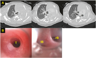 Abb. 2. (A) CT-Serie mit Lungenagenesie links. Trachea (T) mit Bifurkation in rechten Hauptbronchus (rB) und hypoplastischem lin-kem Hauptbronchus (lB). (B) Bronchoskopie von der Trachea (T) bis zur Carina. Auch hier sieht man den hypoplastischen (nicht durchgängigen) linken Hauptbronchus (lB).