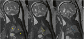 Abb. 1. Linke Lunge nicht abgrenzbar. Rechts Lunge regelrecht (L); keine zystischen Läsionen. Herz (H) sinistroponiert, den linken Hemithorax ausfüllend, Zwerchfell regelrecht, insbesondere links kein Hinweis auf eine Zwerchfellhernie. Gering nach links laterali-sierter Thymus, fetales MRI. H, Herz; L, rechte Lunge; Ö, Ösophagus; T, Trachea; M, Magen; H, Leber
