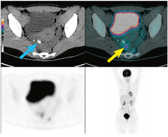 Abbildung 1. FDG PET/CT mit heterogener, partiell verkalkter (blauer Pfeil) und fokaler FDG-aktiver (gelber Pfeil) Läsion in der rechten Adnexe.