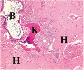 Abbildung 2. Histopathologischer Schnitt mit Bronchus (B), Knochen (K) und reichlich Hirngewebe (H)