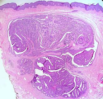Abb. 1. Papillärer Tumor in der Dermis der Vulvarhaut (HE-Färbung 200x; aus File: Hidradenoma Papilliferum of the Vulva (2646470314).jpg – Wikimedia Commons)