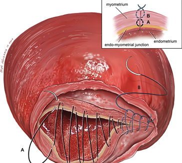 Abb. 2. 2-schichtiger Verschluss ohne Endometrium