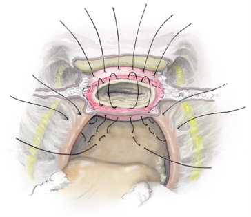 Abb. 4. Der Vaginalverschluss nach «Tail-Hysterektomie (aus: Hohl, M., Hauser, N: Safe totalintrafascial laparoscopic (TAIL) hysterectomy: A prospective cohort study.Gynecol.Surg (2010;7:231–9.)