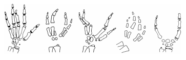 Abb. 3. Formen der medianen Spalthand. Von links der mildesten Form mit Aplasie des Mittelfingerendgliedes bis rechts zur „Hummerscherenhand“ mit Fehlen von Dig 2–4.