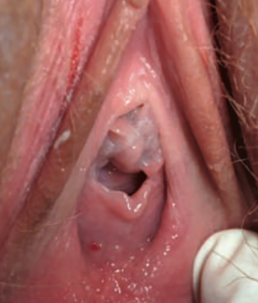Abb. 4. Hymen altus mit enzündlichem Vestibulum
