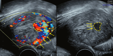 Abb. 2. Im Farbdoppler sieht man, dass diese stark durchblutete Zyste (A) vom angrenzenden Myometrium aus gespeist wird (gelbe Pfeile). (B) Aneurysma ans Cavum angrenzend (Pfeile).
