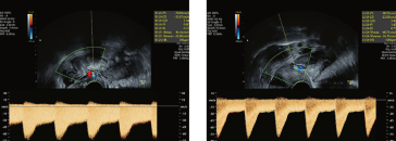 Abb. 3. Doppler beider A. uterinae. Die rechte A. uterina zeigt einen niedrigeren PI. Diese speist auch mehrheitlich diesen hypervaskularisierten Bereich mit Aneurysma im Myometrium.
